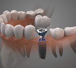 Illustration of a single dental implant in Gahanna, OH