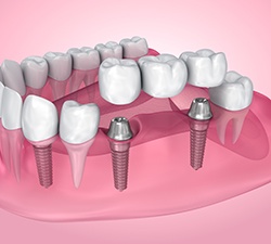 Illustration of an implant bridge for the lower arch