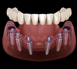 Illustration of a denture being attached to four dental implants in Gahanna, OH