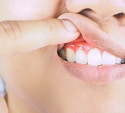 Woman with swollen gums