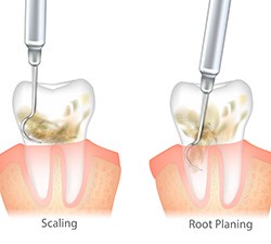 Illustration of scaling & root planing